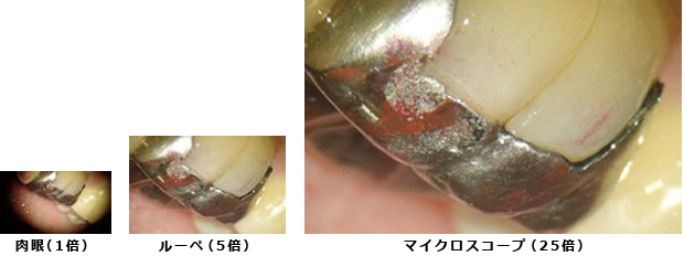 マイクロスコープ（顕微鏡）を使った高度な精密治療